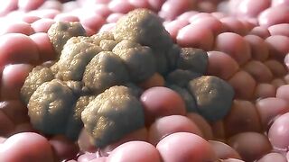 How does a person die from cancer  3D Animation