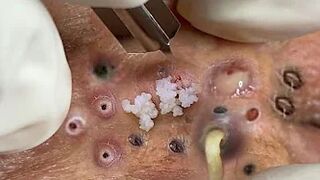 Blackheads Removal | Acne Treatment and Very Satisfying Satisfying Pimple pop #blackheads
