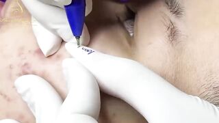 Blackheads Removal | Acne Treatment and Very Satisfying Satisfying Pimple pop #blackheads
