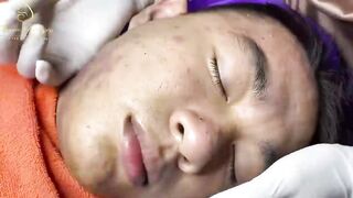 Blackheads Removal | Acne Treatment and Very Satisfying Satisfying Pimple pop #blackheads