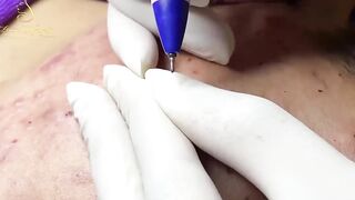 Blackheads Removal | Acne Treatment and Very Satisfying Satisfying Pimple pop #blackheads
