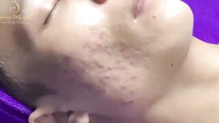 Blackheads Removal | Acne Treatment and Very Satisfying Satisfying Pimple pop #blackheads