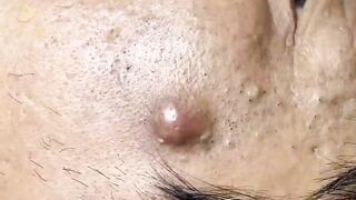 Blackheads Removal | Acne Treatment and Very Satisfying Satisfying Pimple pop #blackheads