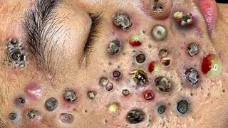 Blackheads Removal | Acne Treatment and Very Satisfying Satisfying Pimple pop #blackheads