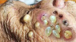 Blackheads Removal | Acne Treatment and Very Satisfying Satisfying Pimple pop #blackheads
