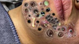 Blackheads Removal | Acne Treatment and Very Satisfying Satisfying Pimple pop #blackheads