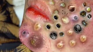 Blackheads Removal | Acne Treatment and Very Satisfying Satisfying Pimple pop #blackheads