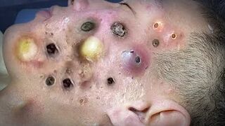 Blackheads Removal | Acne Treatment and Very Satisfying Satisfying Pimple pop #blackheads