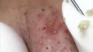 Pimples romoving