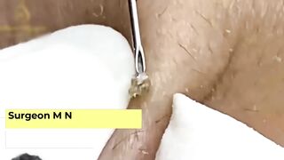 Acne is a common skin condition