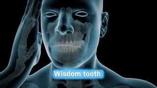 Wisdom Teeth Extraction - Step by step#WisdomTeethExtraction #DentalSurgery
