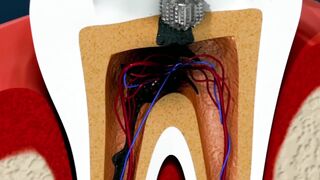 Root Canal Treatment &Tooth Abscess