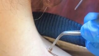 This is how skin tags are treated by cauterization