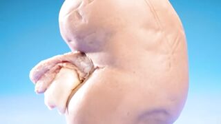 Shocking! What’s REALLY Inside a Kidney Stone?