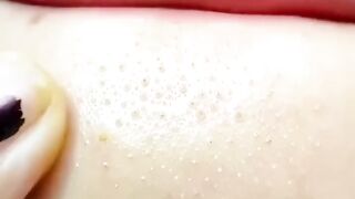 Skin pimple remove#beauty#tips