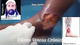 Cuidados y tratamentos da Úlcera Crônica Venosa