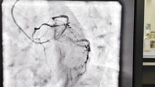 Myocardial Bridging #LAD #cardiology #education