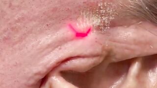 Laser Skin Tightening