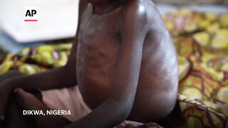 Children die as USAID aid cuts snap lifeline for world's most malnourished.