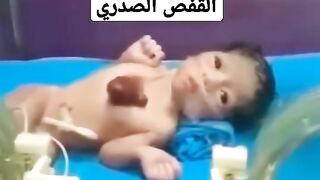 عاجل ???? معجزة✨ شاهد مولود ???? من الأطفال بقلب خارج القفص الصدري.. سبحان الله