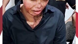 "Disiram Air Keras Suaminya, Perempuan Ini Alami Luka Bakar 83% dan Harus Cicil Biaya Perawatan Rp600 Ribu per Bulan"