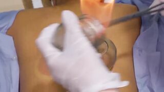ASMR Incredible Chinese Electric Acupuncture with Fire Cupping Chiropractic Massage shorts