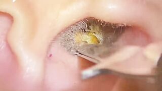 Limpieza de Oídos  Te Arrepentirás de Saltarte Esta Limpieza Profunda