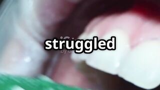 How ProDentim Stopped My Gum Bleeding!