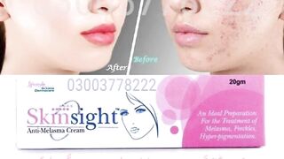 Skinsight Anti Melasma Cream in pakistan 03003778222
