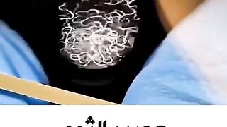 شاهد ماذا يفعل عصير الثوم بـ الطفيليات البشرية
