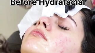 Hydra frcial result
