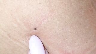 AtHome Peel  Facial Surprise Winner