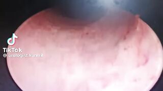 Urethroscopy