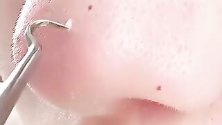 Blackhead Removal Kit
