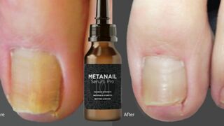 METANAIL COMPLEX REVIEW (HONEST REVIEW 2025) THE TRUTH About Metanail Complex - Nail Health Review
