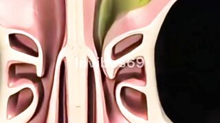 Ever Wonder- How Doctors Clear Sinuses?