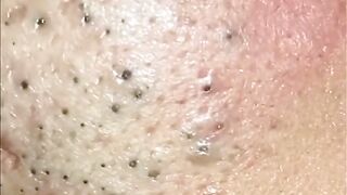 Satisfying Blackhead Extraction  Watch the Transformation!