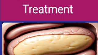 Fatty liver Disease and Causes, Symptoms and Treatment