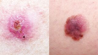 Skin cancer symptoms, causes, diagnosis & treatment