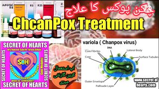 How to get rid of Chikan pox