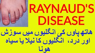 RAYNAUD'S  DISEASE- ھاتھ پاوں کی انگلیوں میں خون کی رکاوٹ