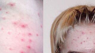 Clear Skin from the Inside Out: The Connection between Gut Health and Acne.