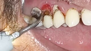 tartar removal indian mouth