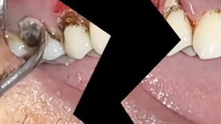Tartar removal indian mouth part 2