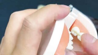 Crazy Tooth Filling! Biting