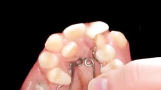 From Chaos to Perfection: Braces Did Their Magic!