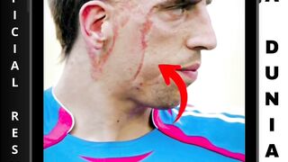 Kenapa diwajah Ribery ada bekas luka permanenn