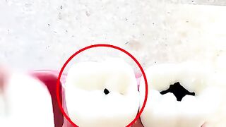 Jangan Remehkan Gigi Berlubang????