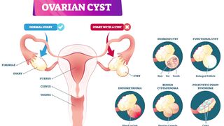 Ovarian cysts symptoms, causes, diagnosis & treatment
