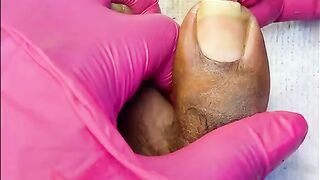 ✅ EXTREME Big Toenail Cleaning & Cuticle Removal ????